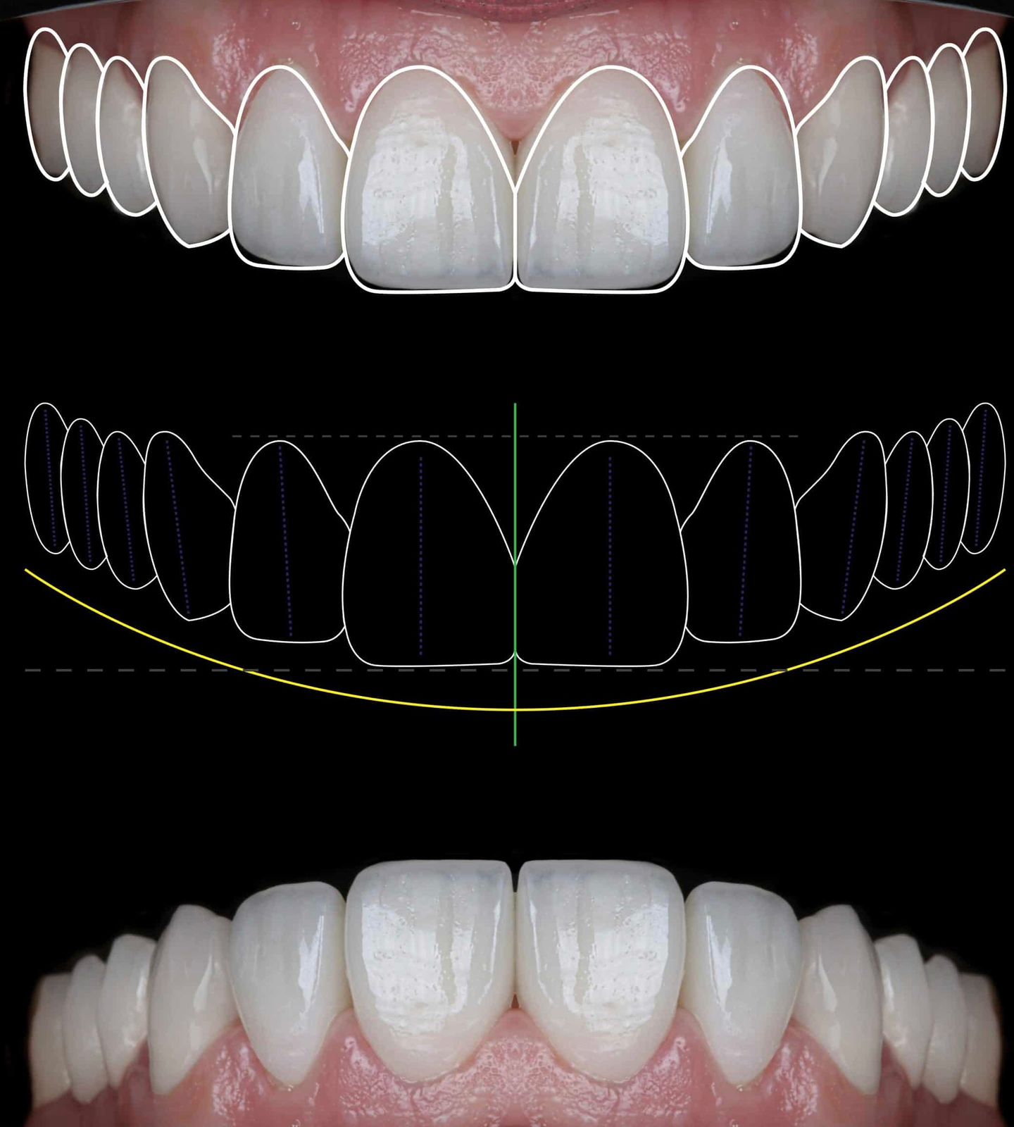 Diseño de sonrisa