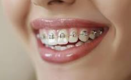 Brackets en Monterrey